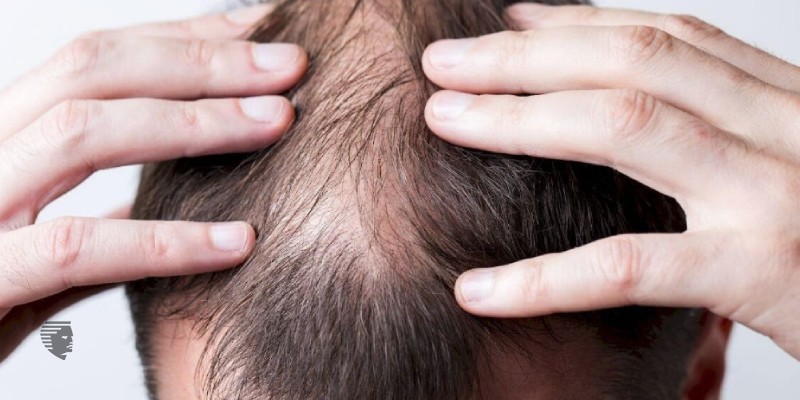 Patchy baldness lowering your confidence Hair fixing is an amazing option