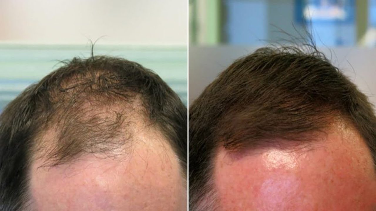 Hair Loss Treatment